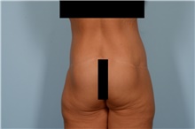 Body Lift After Photo by Ellen Janetzke, MD; Bloomfield Hills, MI - Case 49278