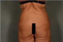 Body Lift Before Photo by Ellen Janetzke, MD; Bloomfield Hills, MI - Case 49278