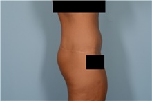 Body Lift After Photo by Ellen Janetzke, MD; Bloomfield Hills, MI - Case 49278