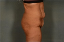 Body Lift Before Photo by Ellen Janetzke, MD; Bloomfield Hills, MI - Case 49278