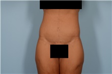 Tummy Tuck After Photo by Ellen Janetzke, MD; Bloomfield Hills, MI - Case 49279