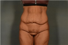 Tummy Tuck Before Photo by Ellen Janetzke, MD; Bloomfield Hills, MI - Case 49279