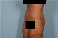 Tummy Tuck After Photo by Ellen Janetzke, MD; Bloomfield Hills, MI - Case 49279