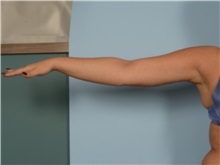 Arm Lift After Photo by Ellen Janetzke, MD; ,  - Case 50291
