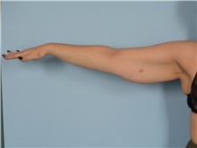 Arm Lift Before Photo by Ellen Janetzke, MD; ,  - Case 50291