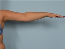 Arm Lift After Photo by Ellen Janetzke, MD; ,  - Case 50291