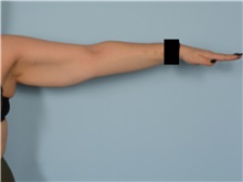 Arm Lift Before Photo by Ellen Janetzke, MD; ,  - Case 50291