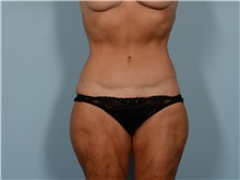 Tummy Tuck After Photo by Ellen Janetzke, MD; ,  - Case 50342