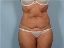 Tummy Tuck Before Photo by Ellen Janetzke, MD; ,  - Case 50342