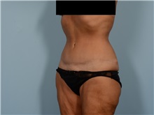 Tummy Tuck After Photo by Ellen Janetzke, MD; ,  - Case 50342