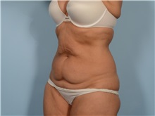 Tummy Tuck Before Photo by Ellen Janetzke, MD; ,  - Case 50342