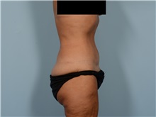 Tummy Tuck After Photo by Ellen Janetzke, MD; ,  - Case 50342