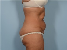 Tummy Tuck Before Photo by Ellen Janetzke, MD; ,  - Case 50342