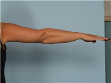 Arm Lift After Photo by Ellen Janetzke, MD; ,  - Case 50343