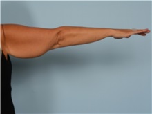 Arm Lift Before Photo by Ellen Janetzke, MD; ,  - Case 50343