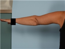Arm Lift After Photo by Ellen Janetzke, MD; ,  - Case 50343