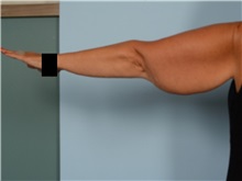 Arm Lift Before Photo by Ellen Janetzke, MD; ,  - Case 50343