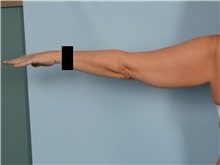 Arm Lift Before Photo by Ellen Janetzke, MD; ,  - Case 50344