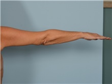 Arm Lift After Photo by Ellen Janetzke, MD; ,  - Case 50344
