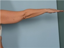 Arm Lift Before Photo by Ellen Janetzke, MD; ,  - Case 50344