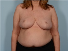 Breast Reduction After Photo by Ellen Janetzke, MD; ,  - Case 50413