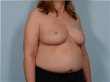 Breast Reduction After Photo by Ellen Janetzke, MD; ,  - Case 50413