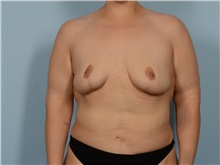 Breast Lift After Photo by Ellen Janetzke, MD; ,  - Case 50415