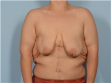 Breast Lift Before Photo by Ellen Janetzke, MD; ,  - Case 50415