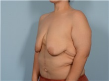 Breast Lift Before Photo by Ellen Janetzke, MD; ,  - Case 50415