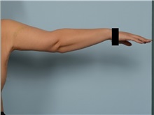 Arm Lift After Photo by Ellen Janetzke, MD; ,  - Case 50414