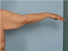 Arm Lift Before Photo by Ellen Janetzke, MD; ,  - Case 50414