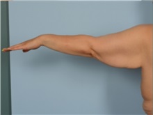 Arm Lift Before Photo by Ellen Janetzke, MD; ,  - Case 50414