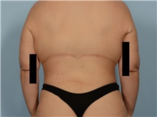Body Lift After Photo by Ellen Janetzke, MD; ,  - Case 50418