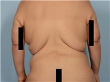 Body Lift Before Photo by Ellen Janetzke, MD; ,  - Case 50418