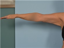 Arm Lift After Photo by Ellen Janetzke, MD; ,  - Case 50533