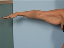 Arm Lift Before Photo by Ellen Janetzke, MD; ,  - Case 50533