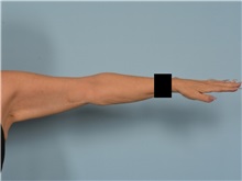 Arm Lift After Photo by Ellen Janetzke, MD; ,  - Case 50533