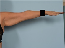 Arm Lift Before Photo by Ellen Janetzke, MD; ,  - Case 50533