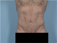 Tummy Tuck After Photo by Ellen Janetzke, MD; ,  - Case 50527