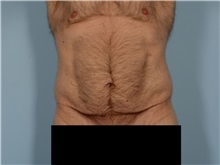 Tummy Tuck Before Photo by Ellen Janetzke, MD; ,  - Case 50527