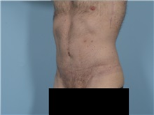 Tummy Tuck After Photo by Ellen Janetzke, MD; ,  - Case 50527