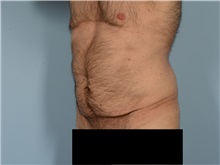 Tummy Tuck Before Photo by Ellen Janetzke, MD; ,  - Case 50527