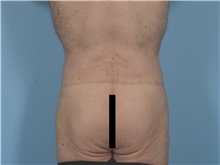 Body Lift After Photo by Ellen Janetzke, MD; ,  - Case 50528