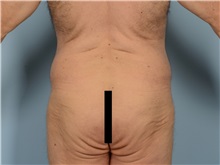 Body Lift Before Photo by Ellen Janetzke, MD; ,  - Case 50528