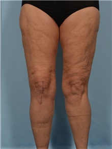Thigh Lift After Photo by Ellen Janetzke, MD; ,  - Case 50534