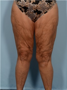Thigh Lift Before Photo by Ellen Janetzke, MD; ,  - Case 50534