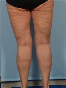 Thigh Lift After Photo by Ellen Janetzke, MD; ,  - Case 50534