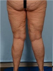 Thigh Lift Before Photo by Ellen Janetzke, MD; ,  - Case 50534