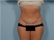 Tummy Tuck After Photo by Ellen Janetzke, MD; ,  - Case 50530