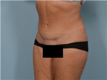 Tummy Tuck After Photo by Ellen Janetzke, MD; ,  - Case 50530